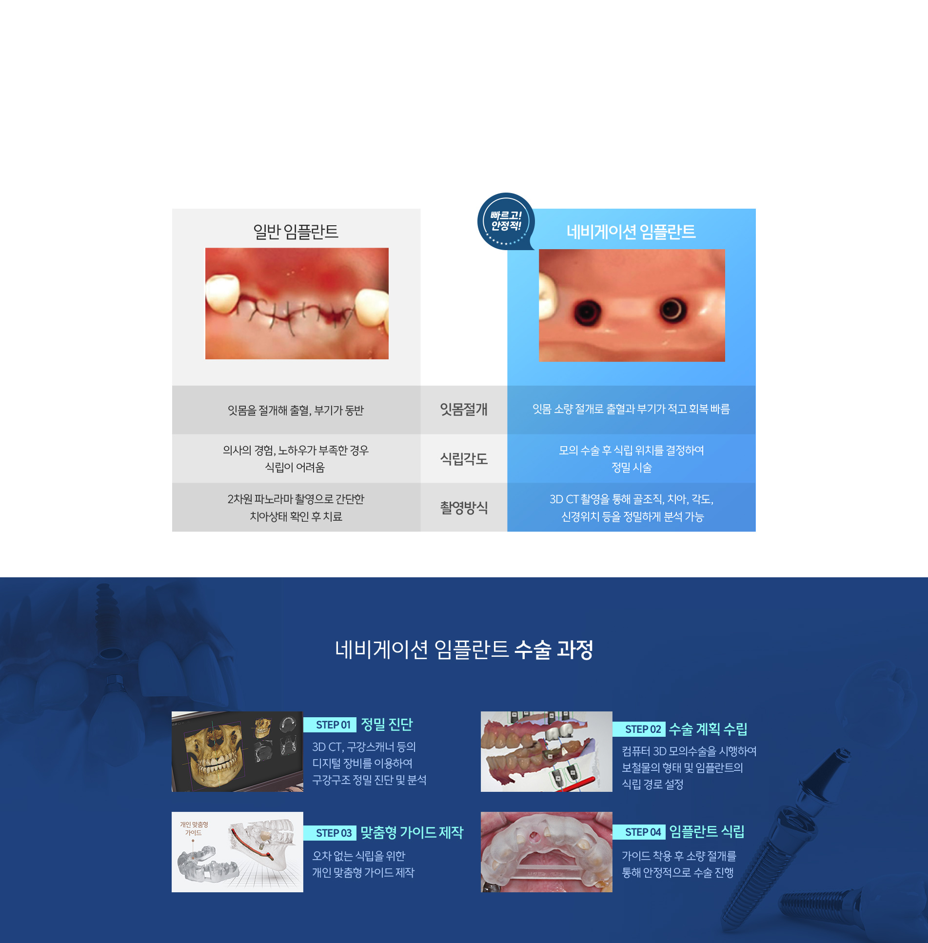 네비게이션 임플란트 | 수술 과정