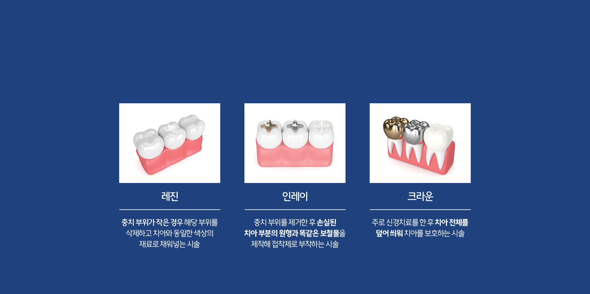 레진 | 인레이 | 크라운