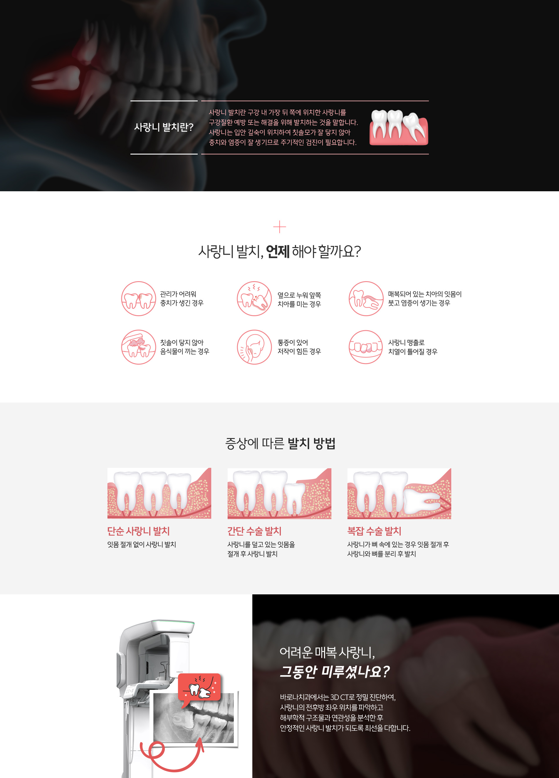 사랑니 발치, 연제 해야 할까요? | 증상에 따른 발치 방법